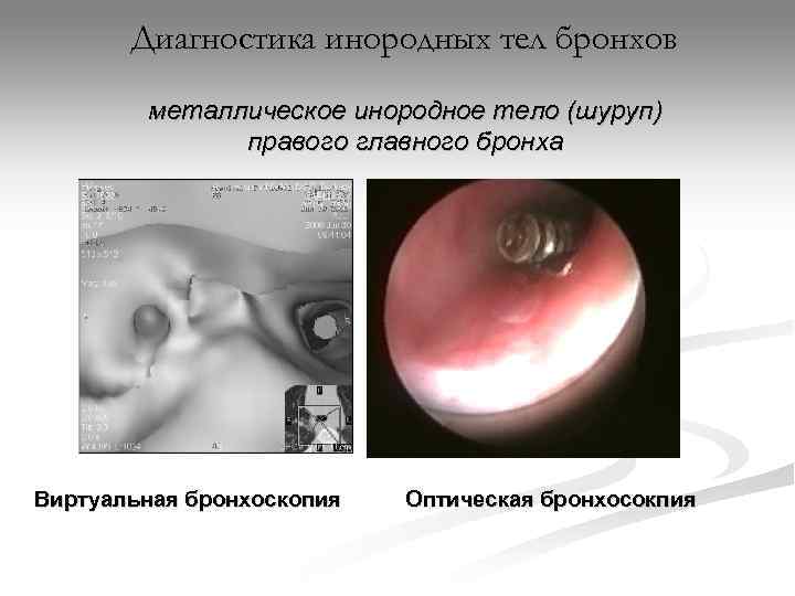   Диагностика инородных тел бронхов   металлическое инородное тело (шуруп)  