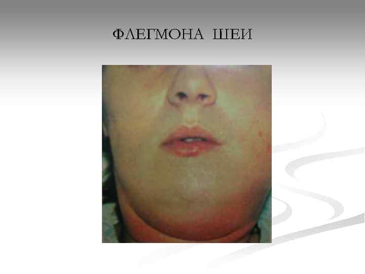 ФЛЕГМОНА ШЕИ 