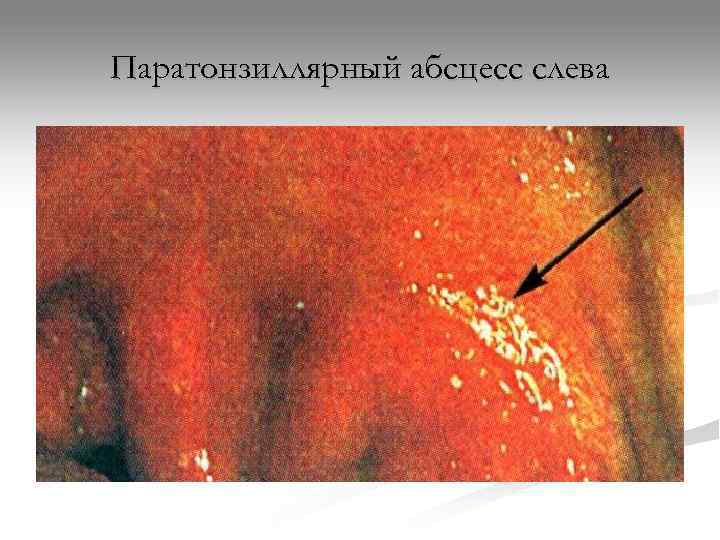 Паратонзиллярный абсцесс слева 