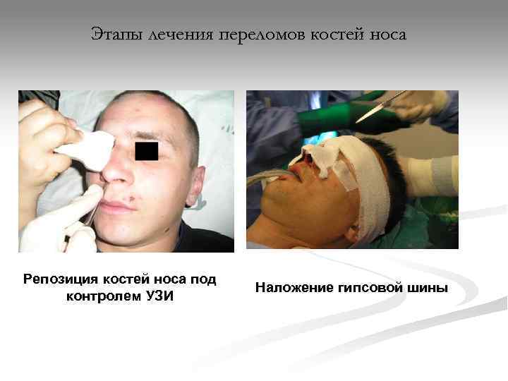   Этапы лечения переломов костей носа Репозиция костей носа под   