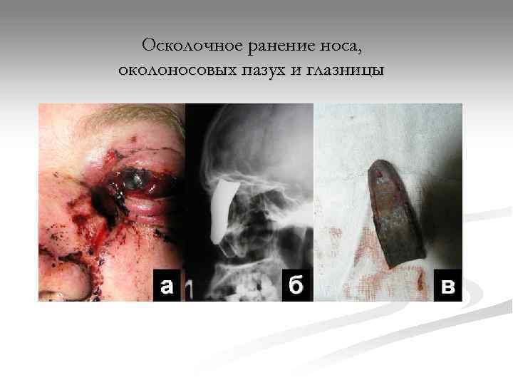  Осколочное ранение носа, околоносовых пазух и глазницы 