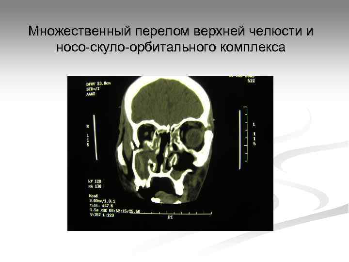 Множественный перелом верхней челюсти и  носо-скуло-орбитального комплекса 