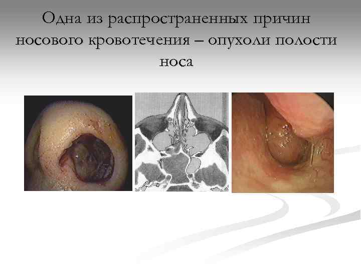   Одна из распространенных причин носового кровотечения – опухоли полости   