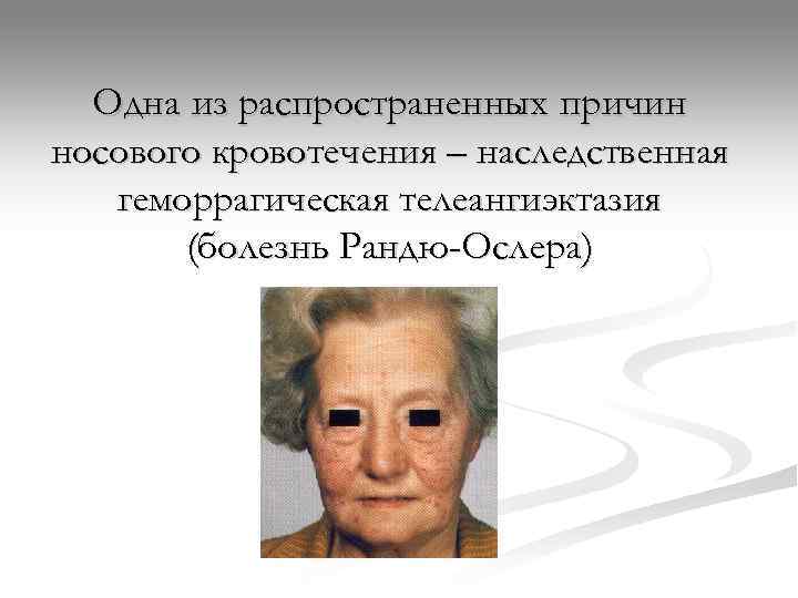  Одна из распространенных причин носового кровотечения – наследственная  геморрагическая телеангиэктазия  (болезнь