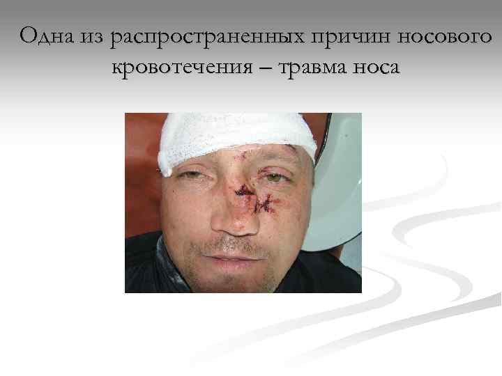Одна из распространенных причин носового   кровотечения – травма носа 