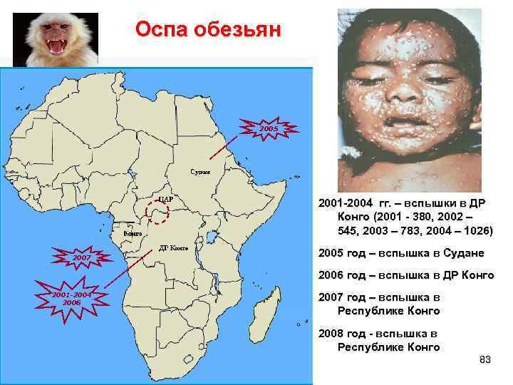   Оспа обезьян     2005     
