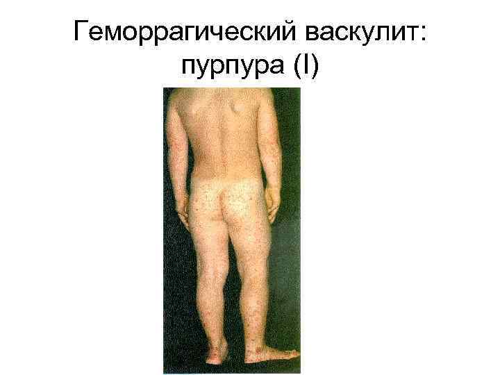 Геморрагический васкулит:   пурпура (I) 