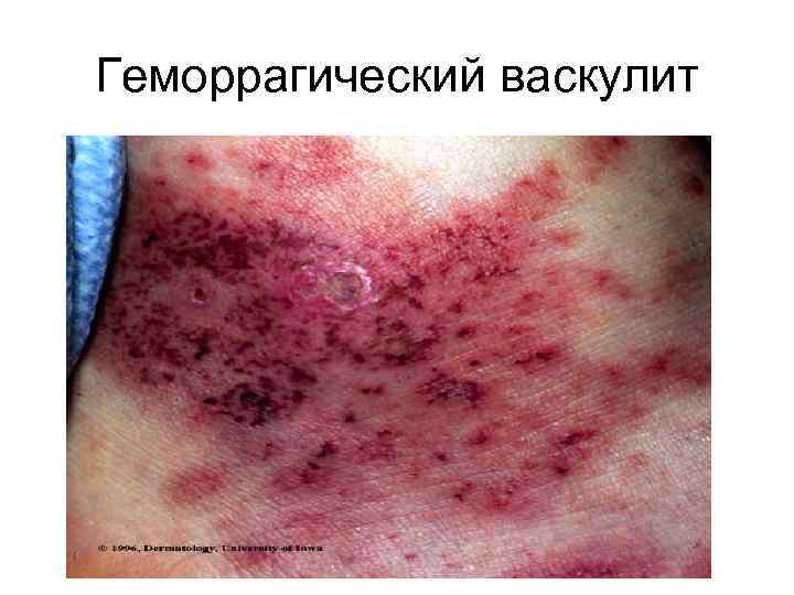 Геморрагический васкулит 
