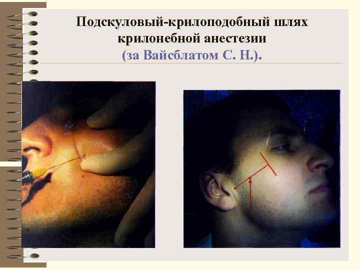 Подскуловый-крилоподобный шлях крилонебной анестезии  (за Вайсблатом С. Н. ). 