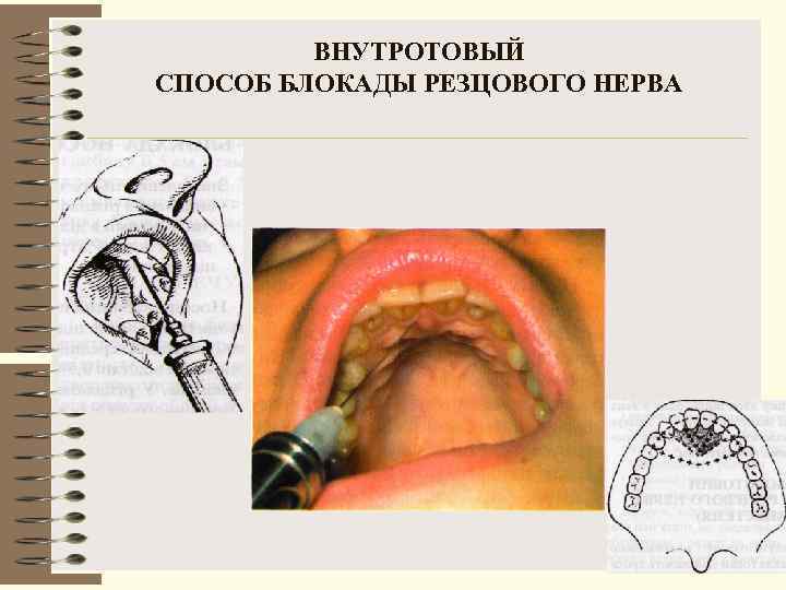    ВНУТРОТОВЫЙ СПОСОБ БЛОКАДЫ РЕЗЦОВОГО НЕРВА 