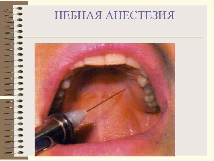 НЕБНАЯ АНЕСТЕЗИЯ 