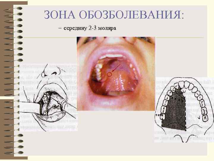 ЗОНА ОБОЗБОЛЕВАНИЯ:  – середину 2 3 моляра 