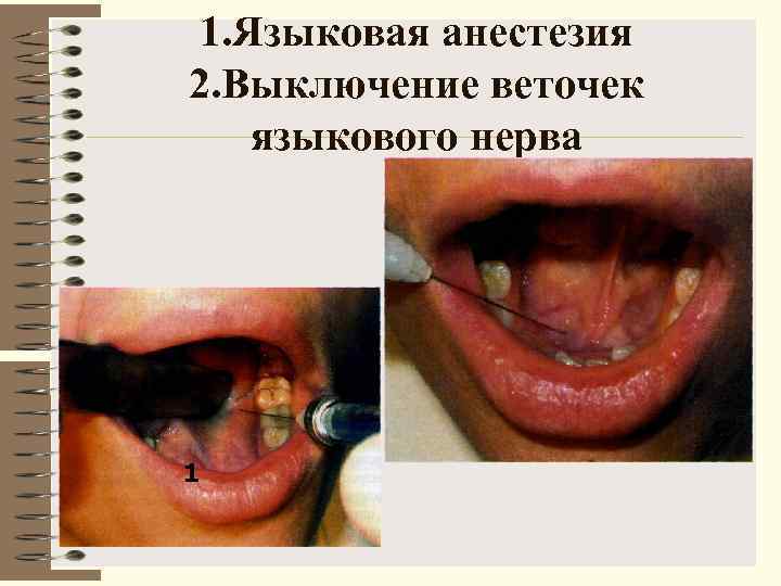  1. Языковая анестезия 2. Выключение веточек языкового нерва    2 1