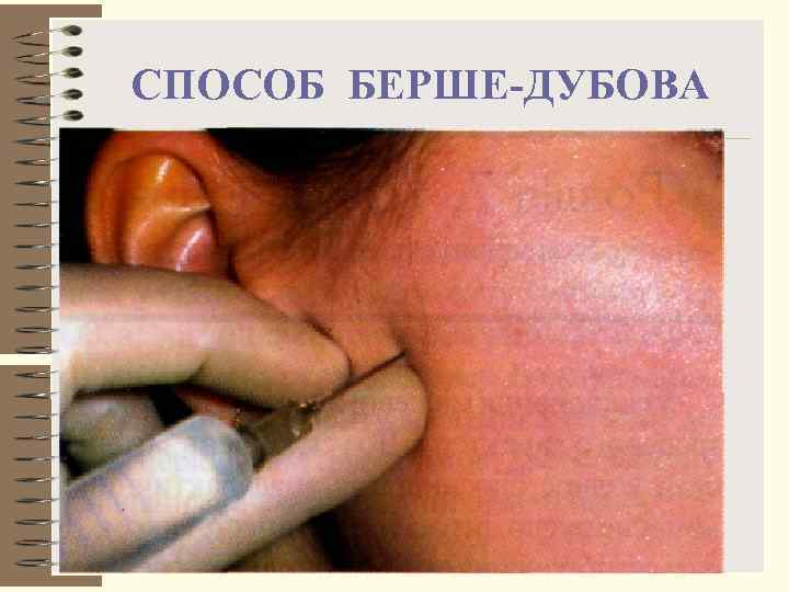 СПОСОБ БЕРШЕ-ДУБОВА 