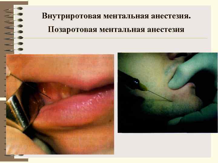 Внутриротовая ментальная анестезия.  Позаротовая ментальная анестезия 