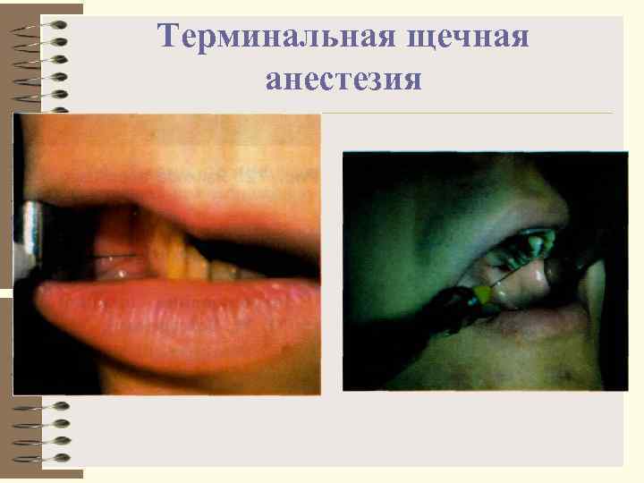Терминальная щечная анестезия 
