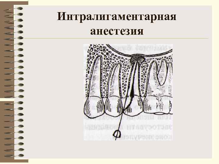 Интралигаментарная анестезия 