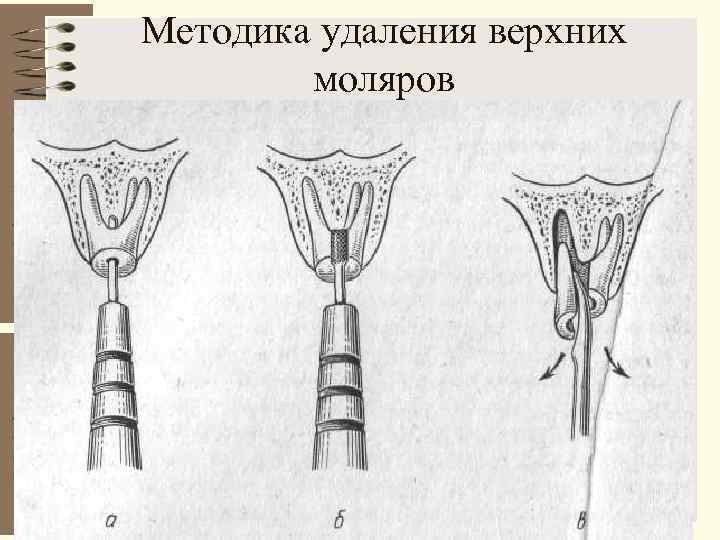 Удаление верхних моляров. Анестезия при удалении верхних моляров. Особенности анестезии верхних моляров.