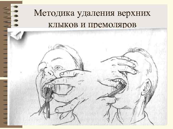 Методика удаления верхних  клыков и премоляров 
