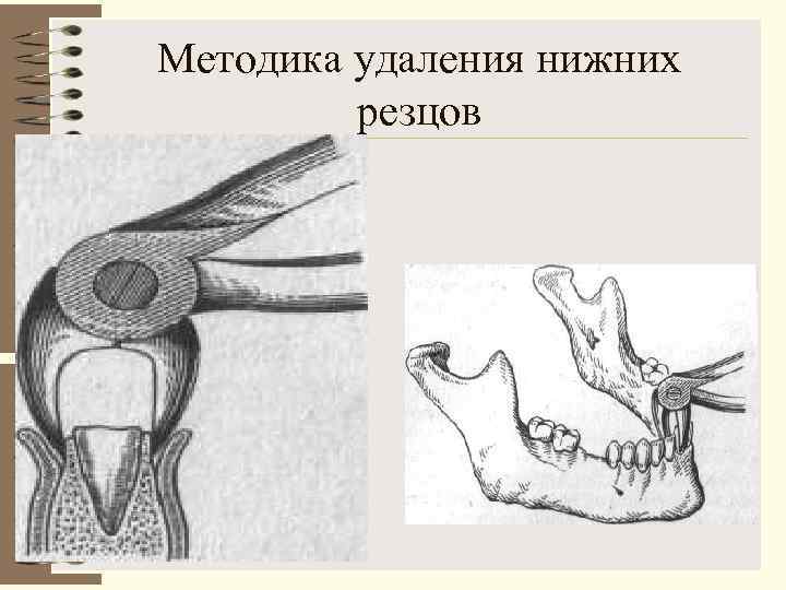 Методика удаления нижних   резцов 