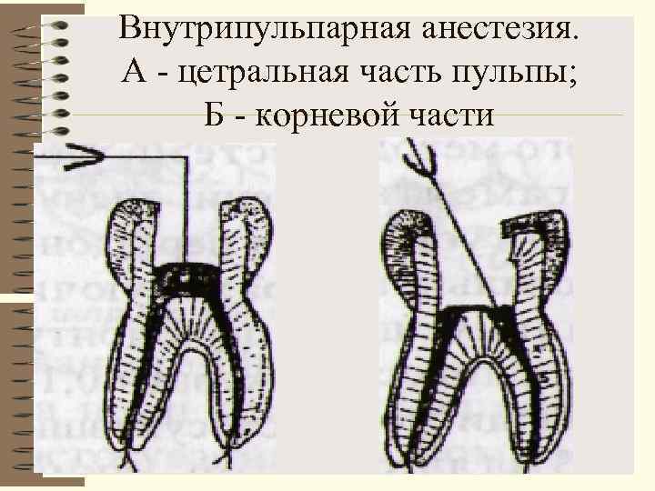 Внутрипульпарная анестезия. А  цетральная часть пульпы;  Б  корневой части 