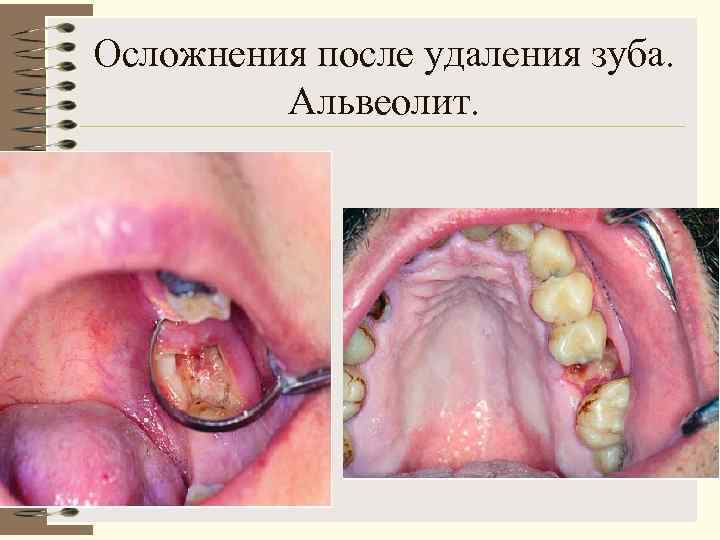 Осложнения после удаления зуба.  Альвеолит. 