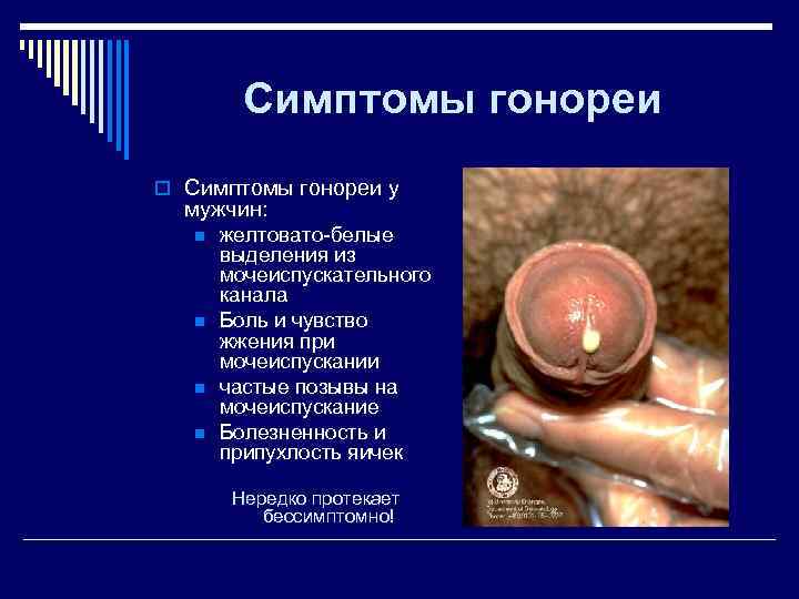    Симптомы гонореи o Симптомы гонореи у  мужчин: n  желтовато-белые