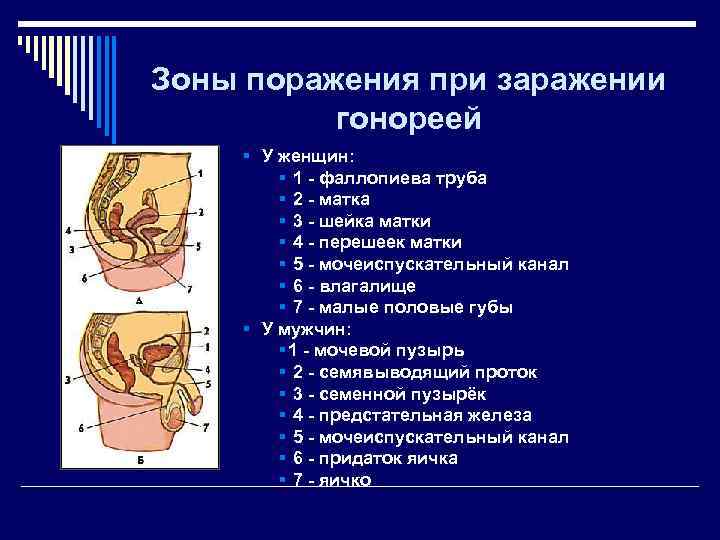 Зоны поражения при заражении  гонореей   У женщин:    1