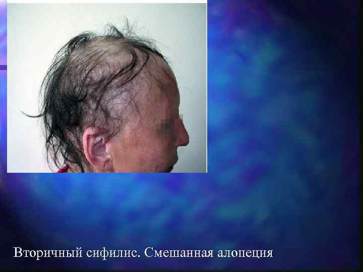 Вторичный сифилис. Смешанная алопеция 