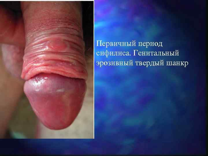 Первичный период сифилиса. Генитальный эрозивный твердый шанкр 