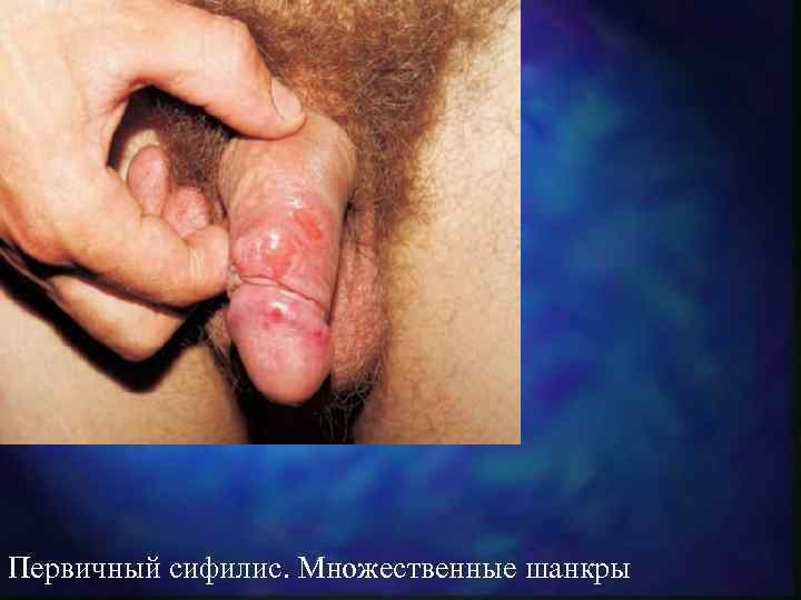 Первичный сифилис. Множественные шанкры 