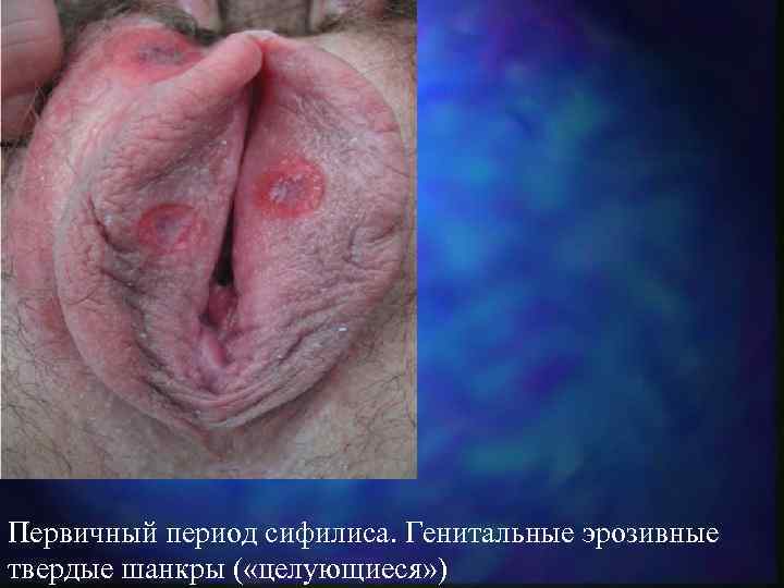 Первичный период сифилиса. Генитальные эрозивные твердые шанкры ( «целующиеся» ) 