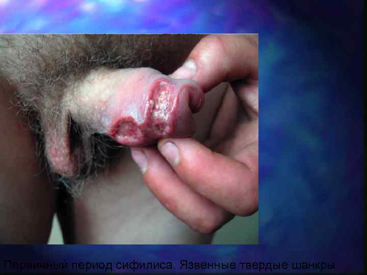 Первичный период сифилиса. Язвенные твердые шанкры 