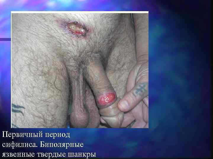 Первичный период сифилиса. Биполярные язвенные твердые шанкры 