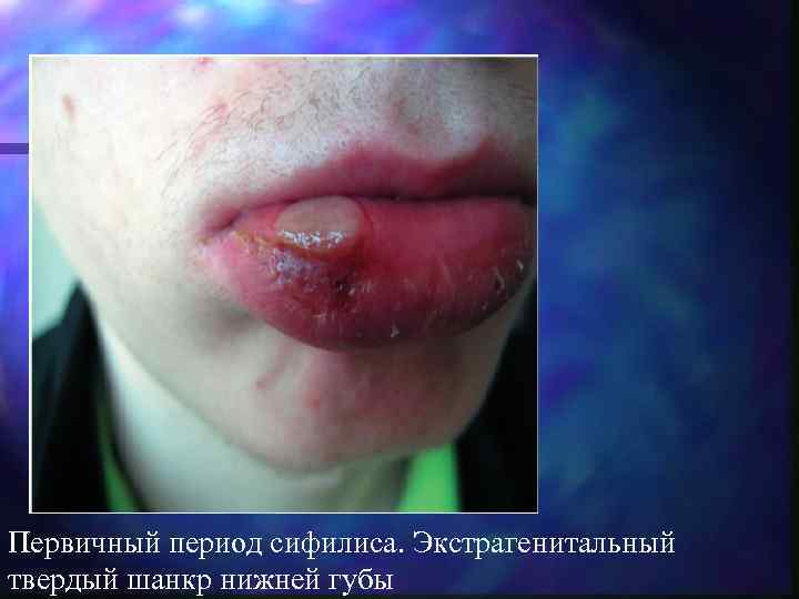 Первичный период сифилиса. Экстрагенитальный твердый шанкр нижней губы 