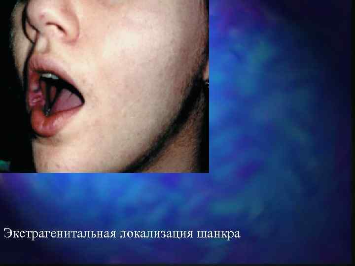 Экстрагенитальная локализация шанкра 