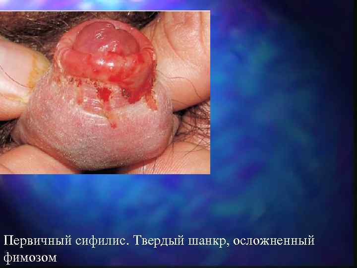 Первичный сифилис. Твердый шанкр, осложненный фимозом 