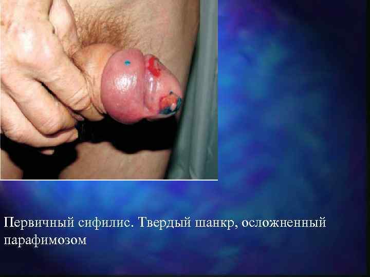Первичный сифилис. Твердый шанкр, осложненный парафимозом 