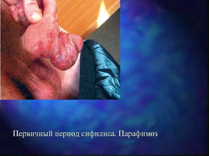 Первичный период сифилиса. Парафимоз 