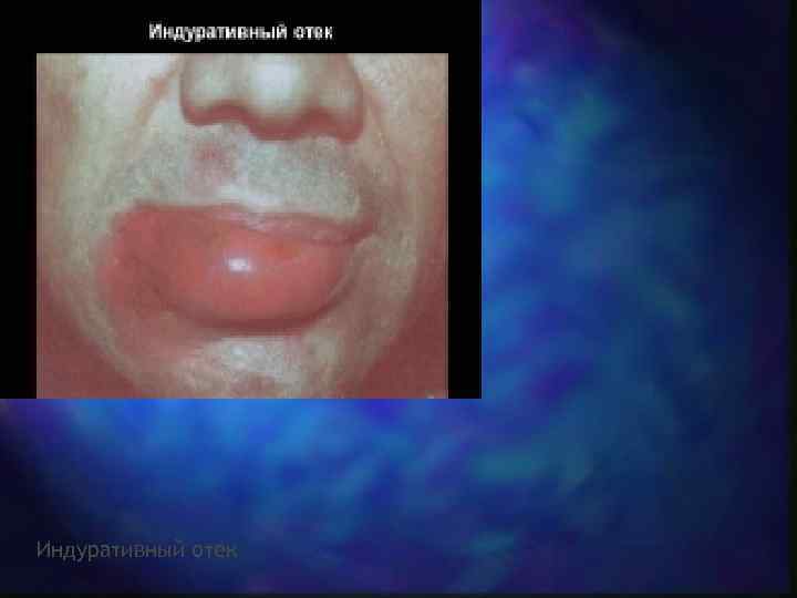 Индуративный отек 