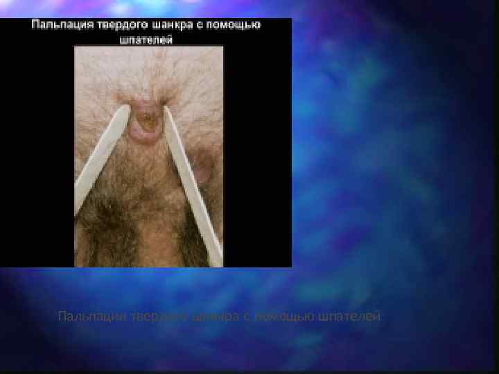 Пальпация твердого шанкра с помощью шпателей 