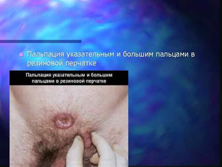 n  Пальпация указательным и большим пальцами в резиновой перчатке 