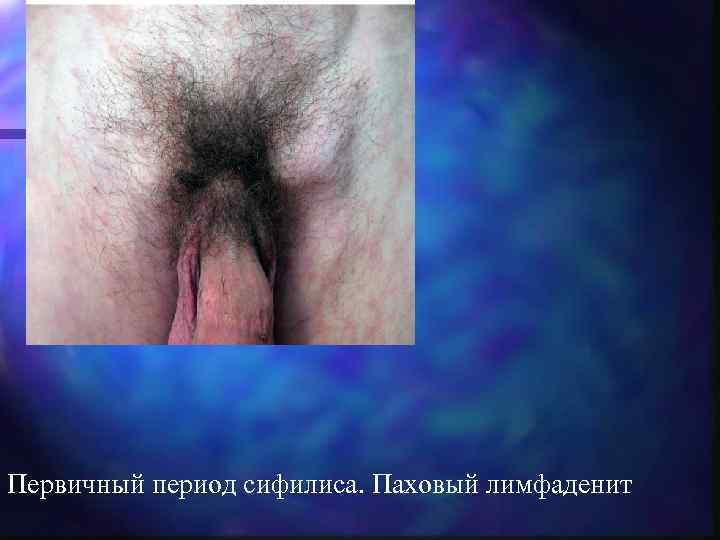 Первичный период сифилиса. Паховый лимфаденит 