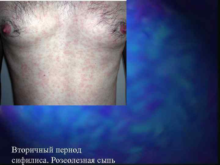 Вторичный период сифилиса. Розеолезная сыпь 