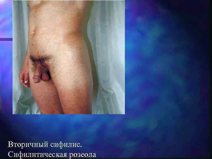 Вторичный сифилис. Сифилитическая розеола 