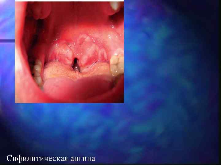 Сифилитическая ангина 