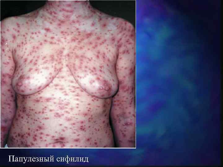 Папулезный сифилид 