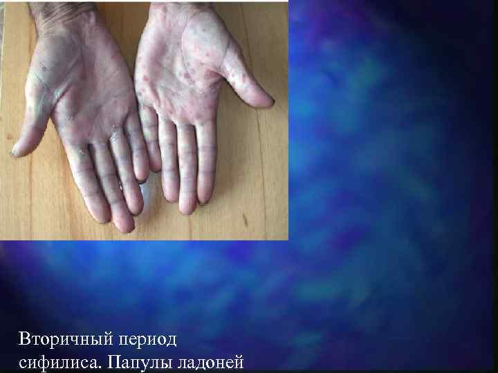 Вторичный период сифилиса. Папулы ладоней 