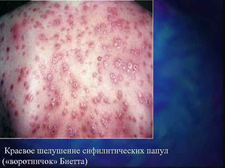  Краевое шелушение сифилитических папул ( «воротничок» Биетта) 