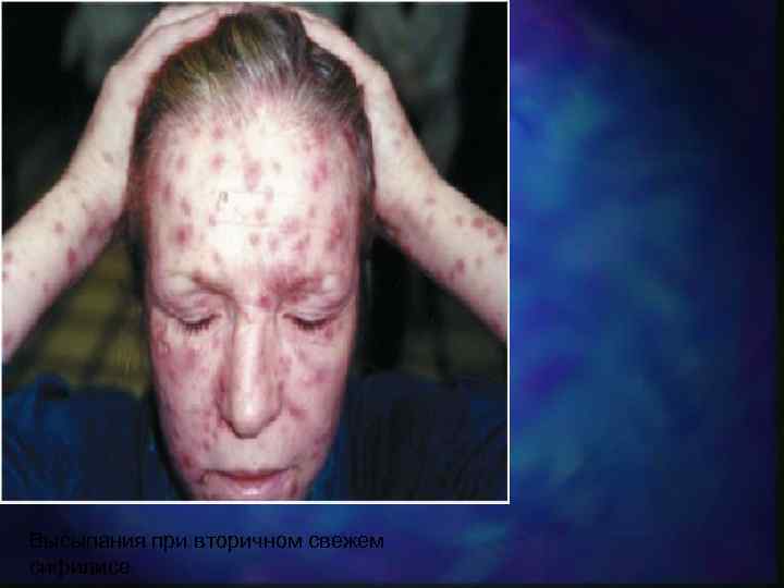 Высыпания при вторичном свежем сифилисе 